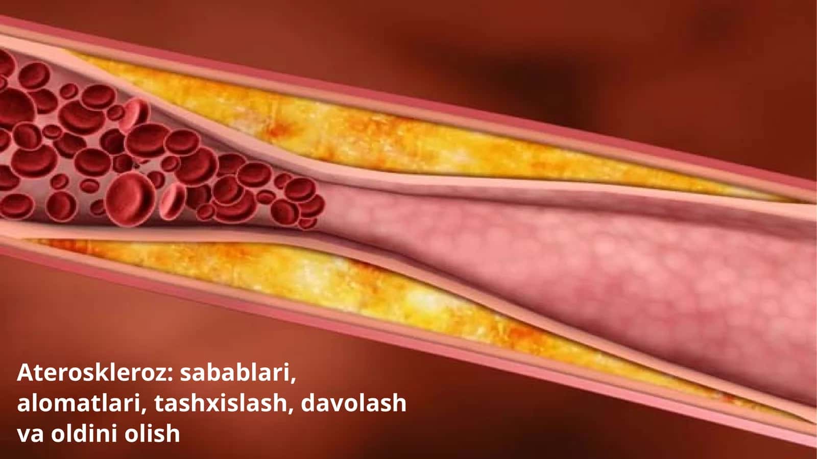 Ateroskleroz: sabablari, alomatlari, tashxislash, davolash va oldini olish