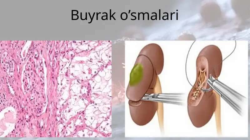 Buyrak o’smalari
